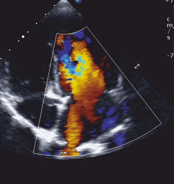 Doppler Ultrasond